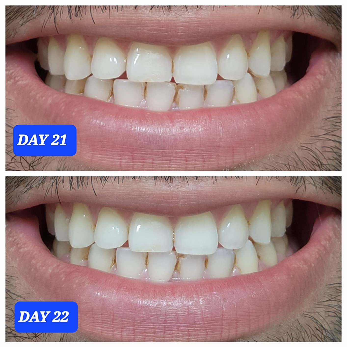 Crest Teeth Whitening Strips, Crest 3D Whitestrips Professional Effects, Enamel Safe Teeth Whitening Kit, 22 Treatments (44 Strips), Professional-Level Whitening, 19 Levels Whiter customer photo 1