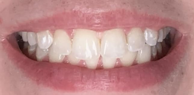 Crest 3D Whitestrips Express Whitening with Light, Whitestrips 3D White, Teeth Whitening Strip Kit, 20 Strips (10 Count Pack), Crest Teeth Whitening Strips, Teeth Whitening Kit customer photo 2