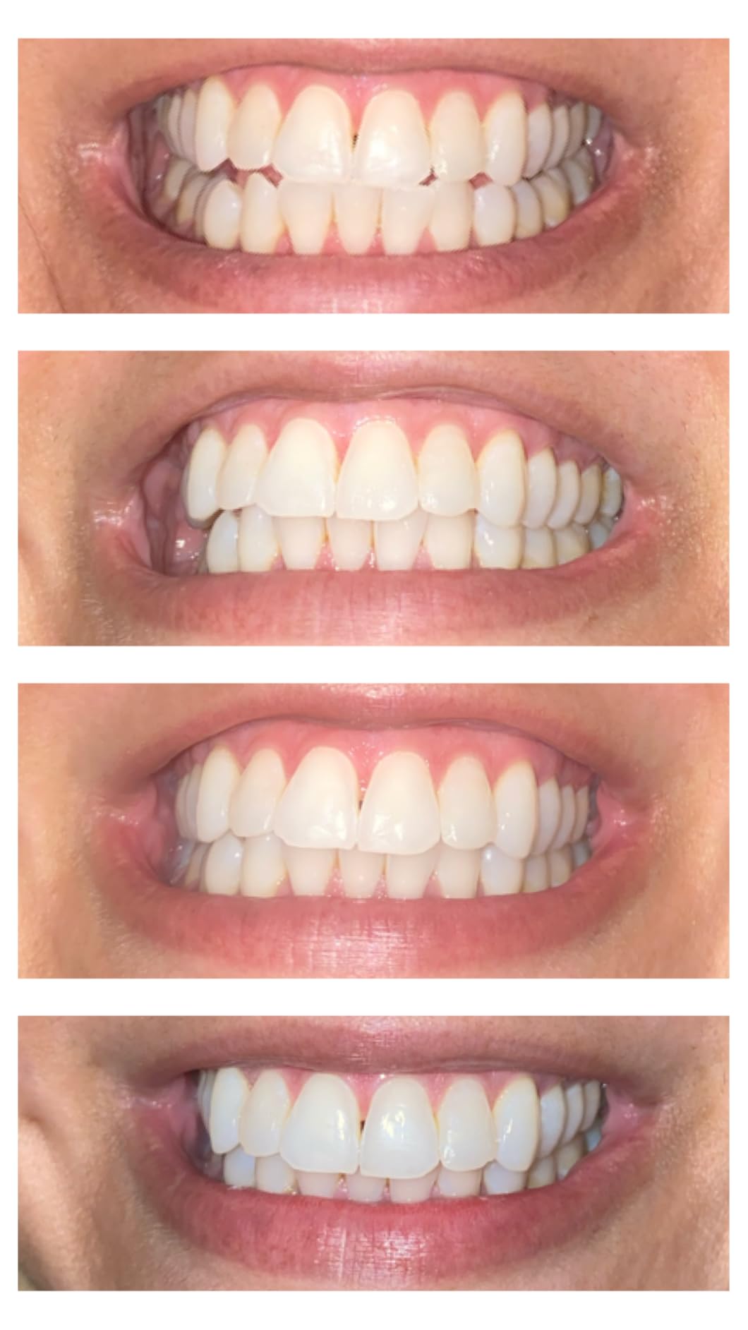 iSmile Teeth Whitening Kit - LED Light, 35% Carbamide Peroxide, (3) 3ml Gel Syringes, (1) Remineralization Gel, and Tray. customer photo 2