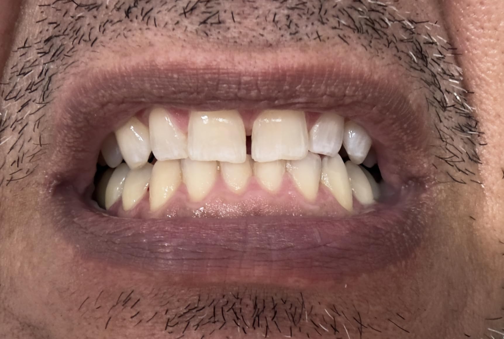 Crest Teeth Whitening Strips, Crest 3D Whitestrips 2 Week Smile Transformation, Enamel Safe Teeth Whitening Kit, 16 Treatments (32 Strips), Whiter Teeth in 2 Weeks, 11 Levels Whiter customer photo 2