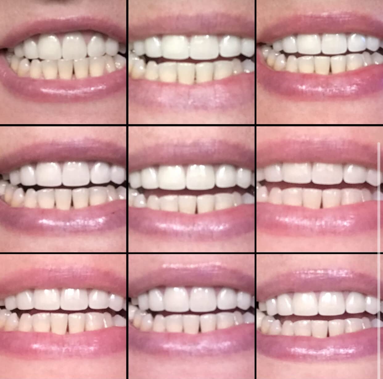 SmileDirectClub Teeth Whitening Kit with LED Light - 4 Pack Gel Pens - Professional Strength Hydrogen Peroxide customer photo 2