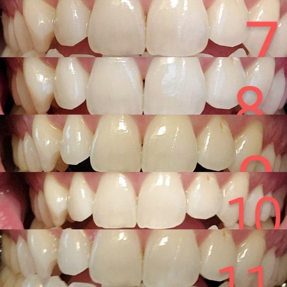 MySmile Teeth Whitening LED Light w/Mouth Tray Home Oral Whitening Device customer photo 1