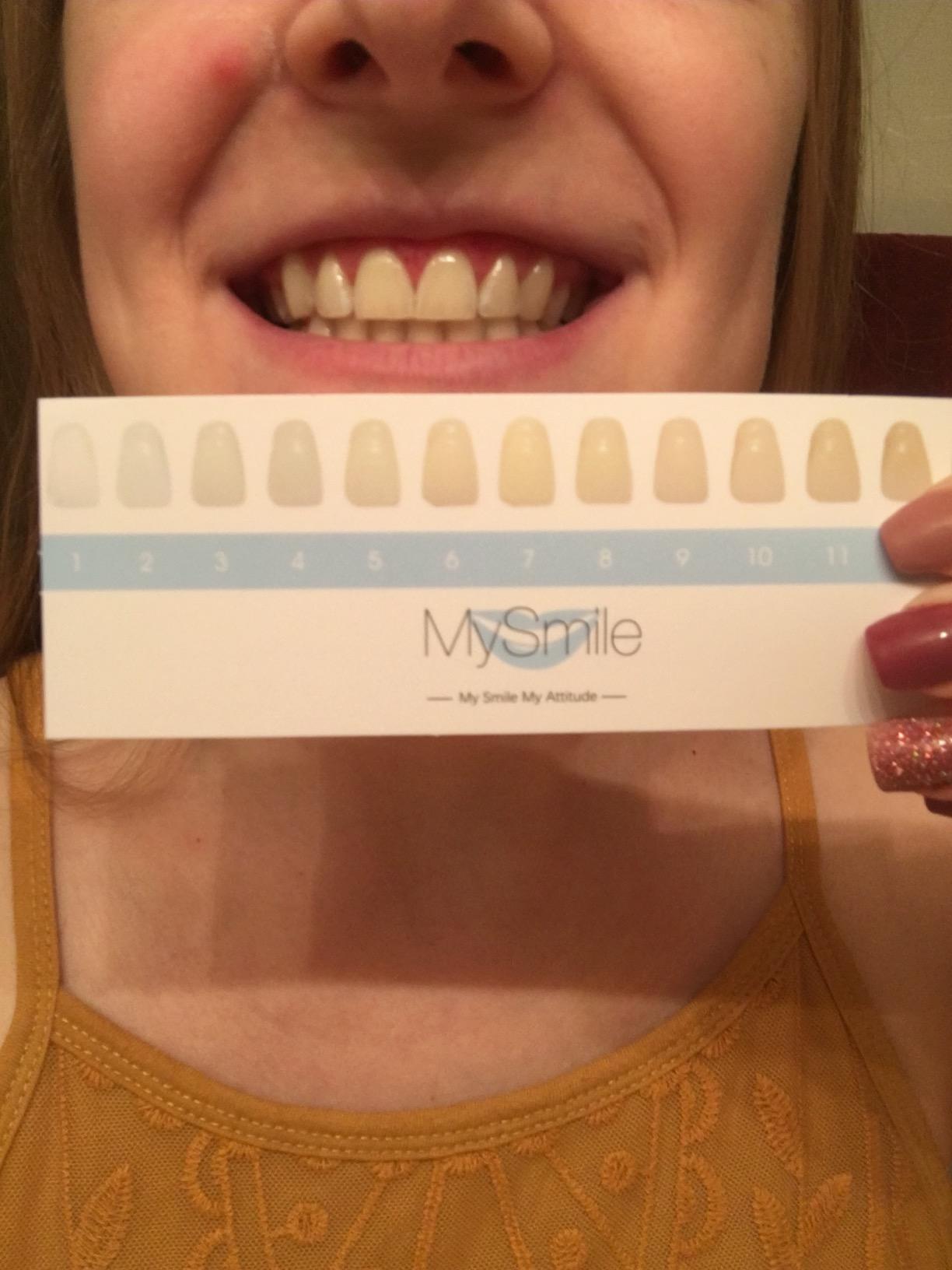 MySmile Teeth Whitening LED Light w/Mouth Tray Home Oral Whitening Device customer photo 2